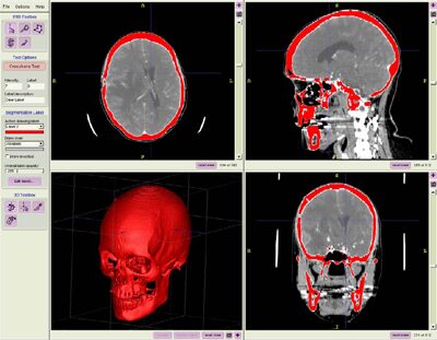 Automating the Extraction of 3D Models from Medical Images for Virtual Reality and Haptic Simulations