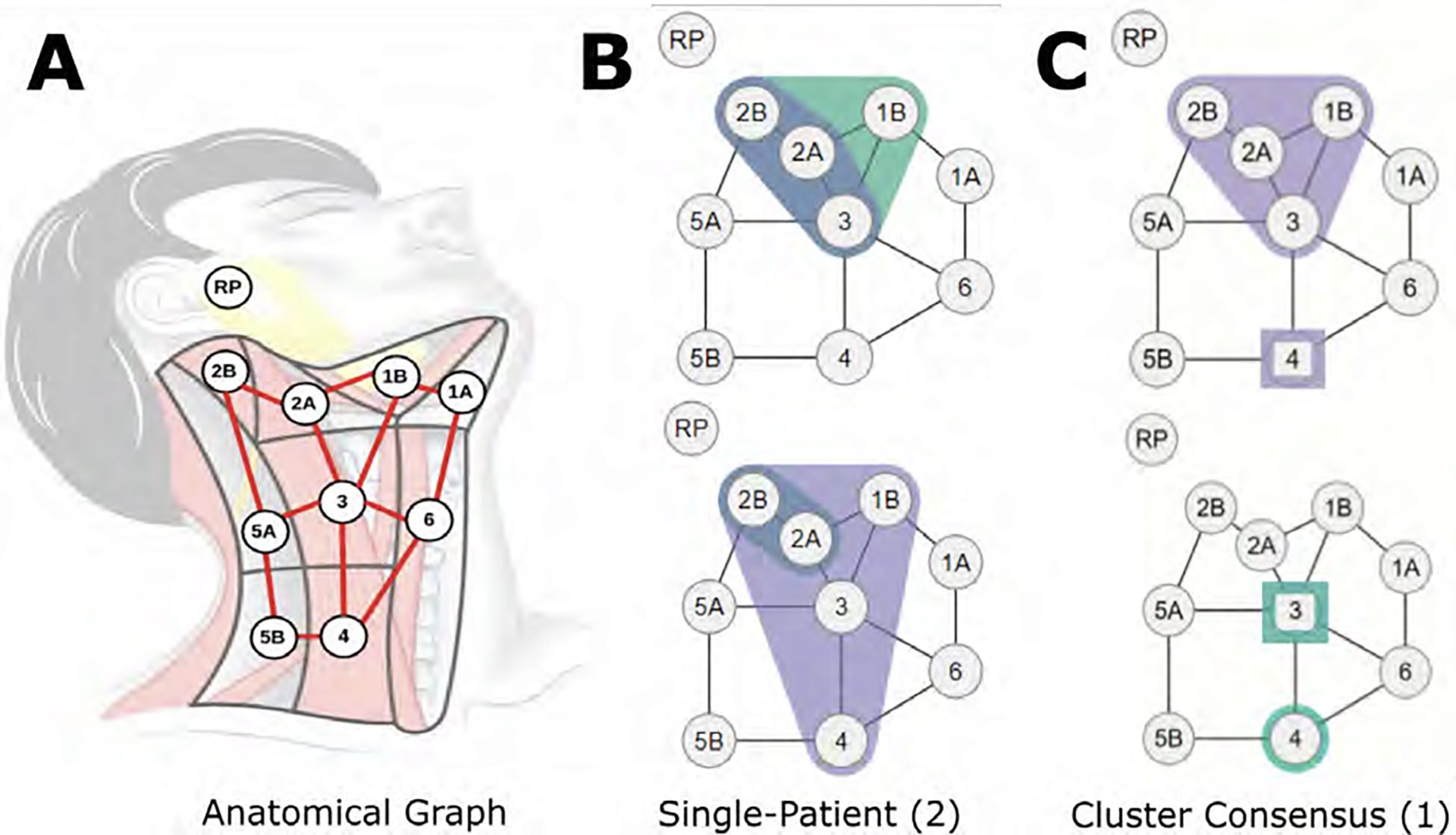 (A) Lymph nodes overlaid over a diagram of the neck. (B) Example graphs of diseased nodes for 2 individual patients (datapoint representation). (C) Example consensus graph for 1 cluster (cluster representation).