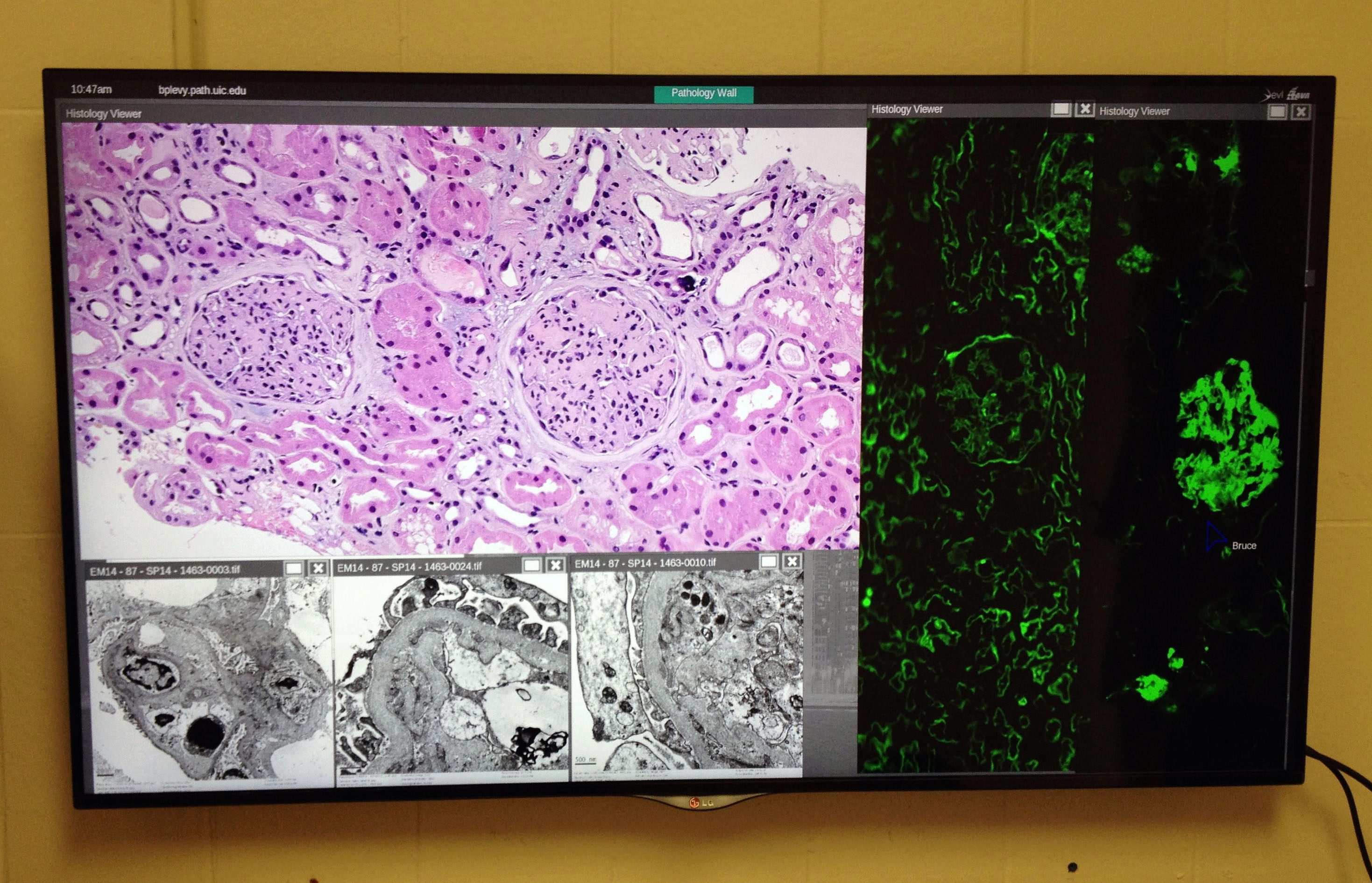 A one-sceen SAGE wall in Bruce Levy's office shows the potential for a pathologis's cockpit that enables him to view a case digitally instead of with a microscope.